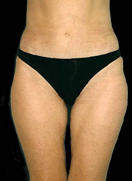 Liposuction Before & After Patient #11543