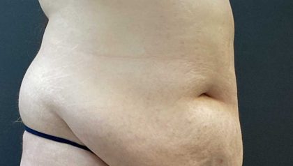 Tummy Tuck Before & After Patient #11487