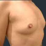 Breast Augmentation Before & After Patient #11500