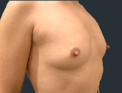 Breast Augmentation Before & After Patient #11500