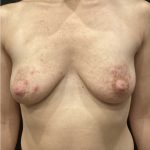 Breast Augmentation Before & After Patient #11510