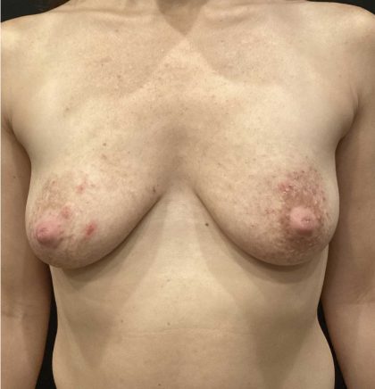 Breast Augmentation Before & After Patient #11510