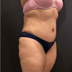 Liposuction Before & After Patient #11526