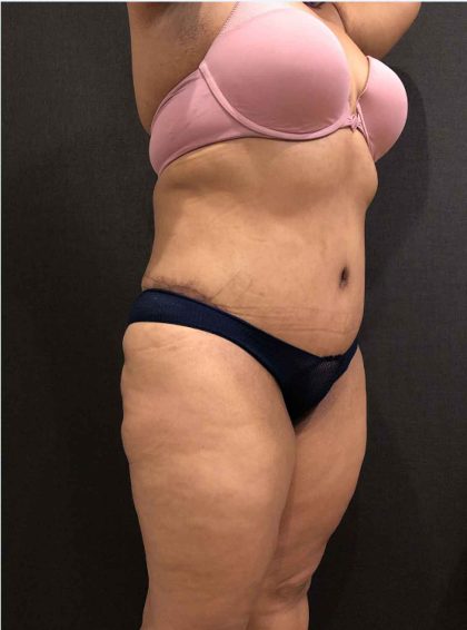 Liposuction Before & After Patient #11526