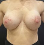 Breast Augmentation Before & After Patient #11510