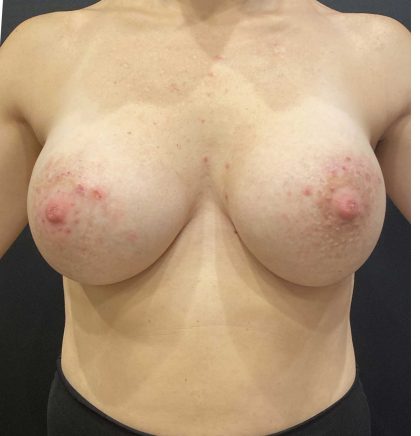 Breast Augmentation Before & After Patient #11510