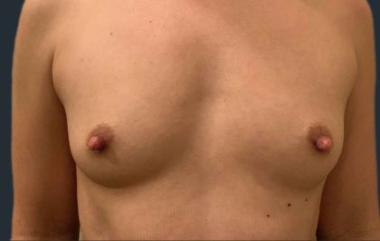 Breast Augmentation Before & After Patient #11500