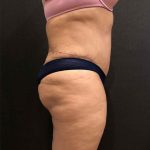 Liposuction Before & After Patient #11526