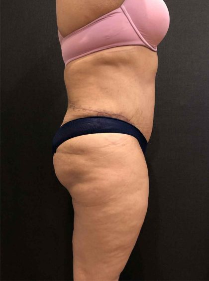 Liposuction Before & After Patient #11526