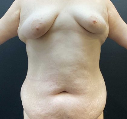 Breast Lift Before & After Patient #11487