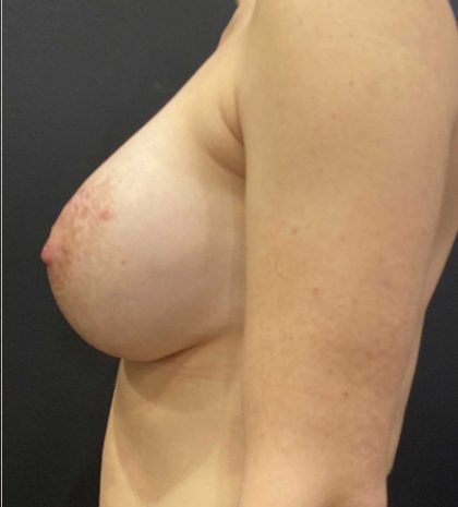 Breast Augmentation Before & After Patient #11510