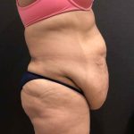 Liposuction Before & After Patient #11526