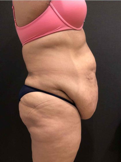 Liposuction Before & After Patient #11526