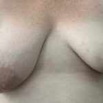 Breast Lift Before & After Patient #11487