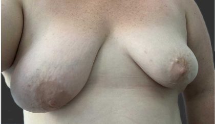 Breast Lift Before & After Patient #11487