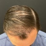 Hair Restoration with Neograft Before & After Patient #11517