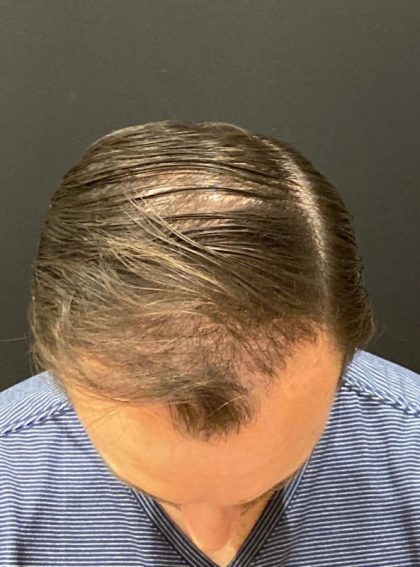 Hair Restoration with Neograft Before & After Patient #11517