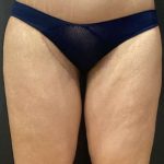 Liposuction Before & After Patient #11450