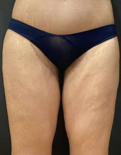 Liposuction Before & After Patient #11450