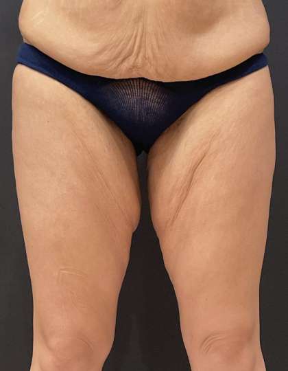 Liposuction Before & After Patient #11450