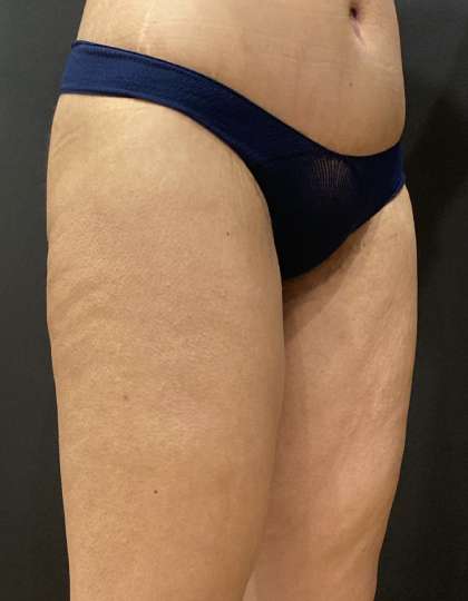 Liposuction Before & After Patient #11450