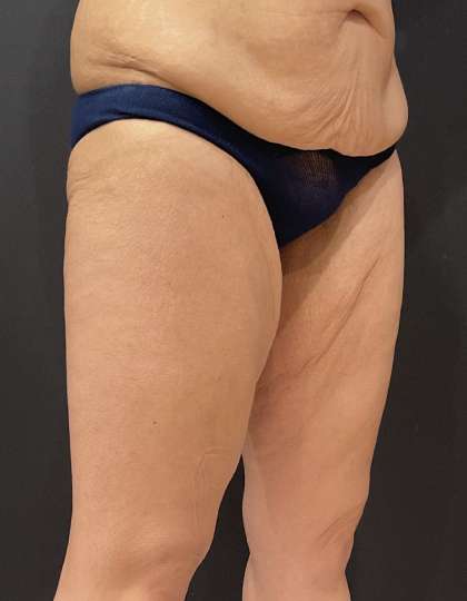 Liposuction Before & After Patient #11450