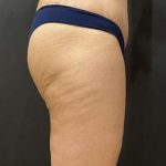 Liposuction Before & After Patient #11450