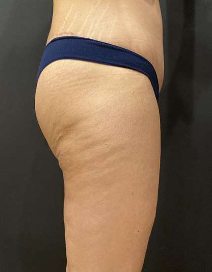 Liposuction Before & After Patient #11450