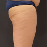 Liposuction Before & After Patient #11450