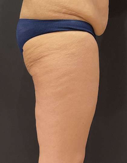 Liposuction Before & After Patient #11450