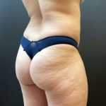 Fat Transfer to Butt Before & After Patient #11611