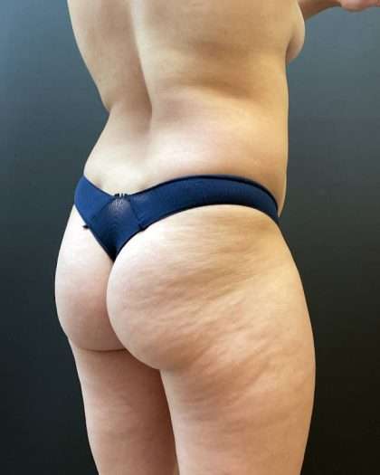 Fat Transfer to Butt Before & After Patient #11611