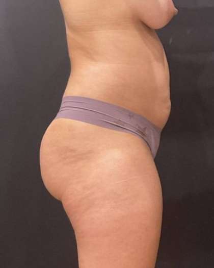 Fat Transfer to Butt Before & After Patient #11611