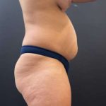 Fat Transfer to Butt Before & After Patient #11611