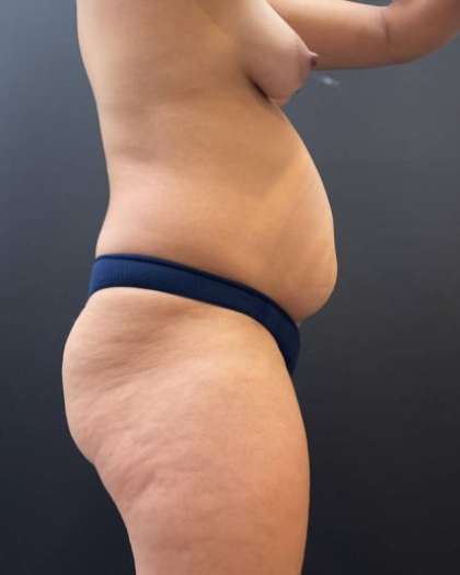 Fat Transfer to Butt Before & After Patient #11611