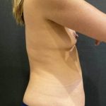 Liposuction Before & After Patient #11616