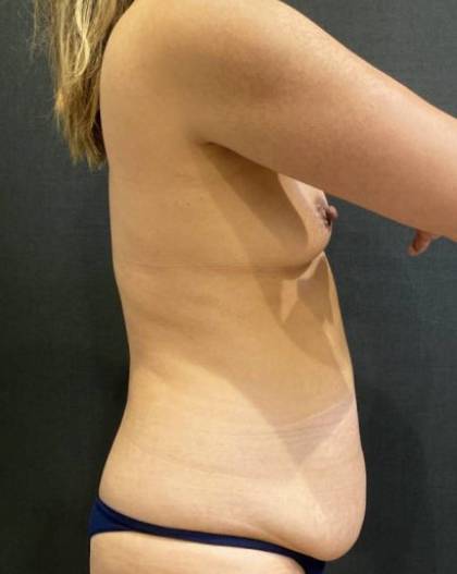Liposuction Before & After Patient #11616