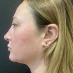 Rhinoplasty Before & After Patient #11591