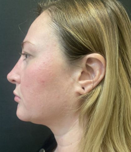 Rhinoplasty Before & After Patient #11591