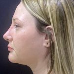 Rhinoplasty Before & After Patient #11591