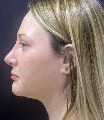 Rhinoplasty Before & After Patient #11591