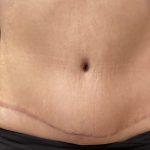 Tummy Tuck Before & After Patient #11598