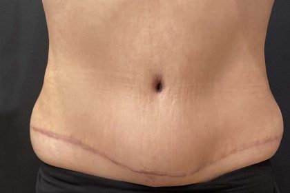 Tummy Tuck Before & After Patient #11598