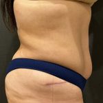 Tummy Tuck Before & After Patient #11598