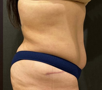 Tummy Tuck Before & After Patient #11598