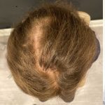 Hair Restoration with PRP Before & After Patient #11672
