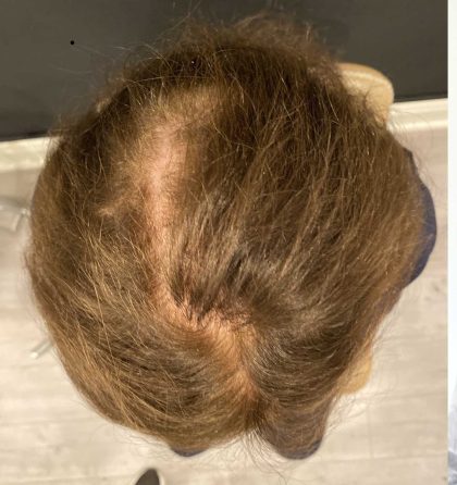 Hair Restoration with PRP Before & After Patient #11672