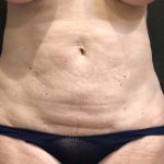 Liposuction Before & After Patient #11632