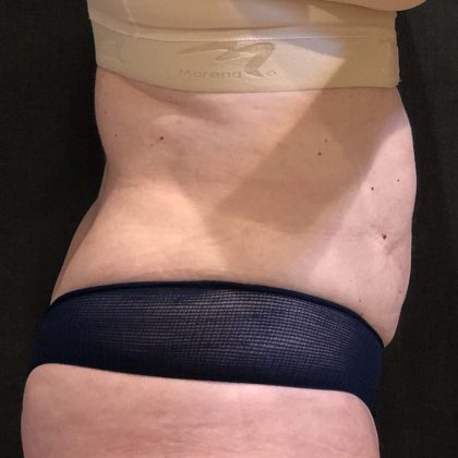 Liposuction Before & After Patient #11632