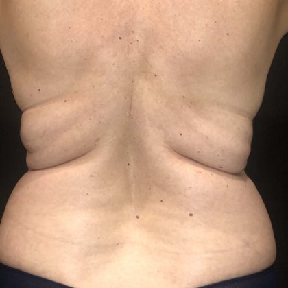 Liposuction Before & After Patient #11632
